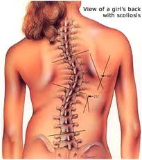 Scoliosis